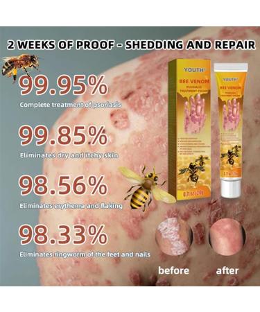 Youth Bee Venom Psoriasis Treatment Cream Bee Venom Psoriasis Treatment Cream New Zealand Bee Venom Professional Psoriasis Treatment Cream Soothing and Moisturizing Psoriasis Cream (5pcs) - Buy Online on GoSupps.com