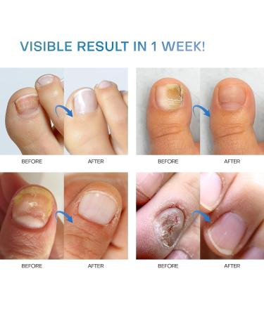 HealPool Extra Strength Toenail Treatment - 2 pcs Nail Treatment for Discolored or Damaged Nails - Fungus Nail Renewal - Buy Online on GoSupps.com