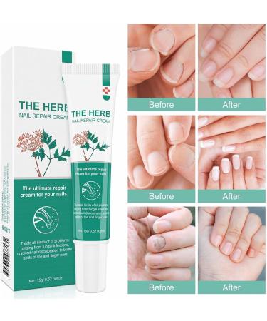 Nail Repair Cream Effective Fungal Nail Treatment for Toenails Fungus Nail Cream Nourishing For Restores Discolored & Damaged Strong Nail Fungus Treatment for Toenail Restores Healthy Appearance - Buy Online on GoSupps.com