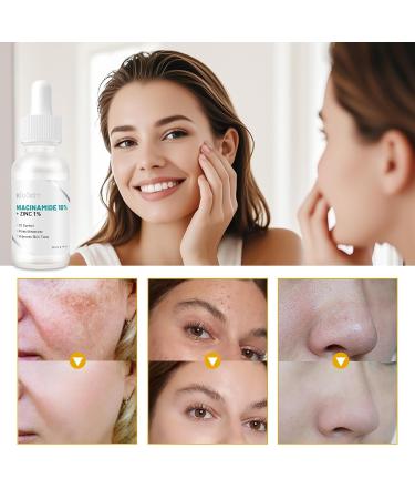 Niacinamide 10% + Zinc 1% Serum for Women - Niacinamide Serum for Face - Controls Oil Shrinks Pores Reduces Redness & Tones Skin - Deeply Hydrating Gentle for All Skin Types - Buy Online on GoSupps.com