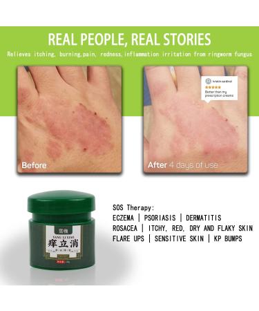 Gentle Chinese Herbal Eczema Cream - Anti-Itch Dermatitis Relief for Dry, Irritated Skin - Psoriasis, Shingles, Acne, Rosacea Ointment - 0.7 Ounce - Buy Online on GoSupps.com