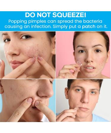 Acne Pimple Micropoint Patches - 18 Count (2 Packs) | Best Spot Treatment for Inflamed Cystic Acne and Hormonal Breakouts - Buy Online on GoSupps.com