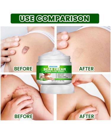 Scar Gel | Natural Calming Moisturizing Aloe Gel for Skin Lightening - Professional Scar Eraser Non-greasy Scar Repair Skin Care for Wounds Sysdisen - Buy Online on GoSupps.com