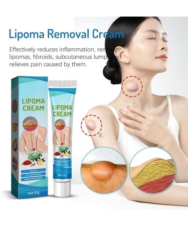 GeRRiT Lipoma Removal Cream Soothing Ointment for Lipoma Natural Lipoma Removal Cream Anti-Swelling Lymphatic Detox Breastfeeding Cream for Skin Care - Buy Online on GoSupps.com