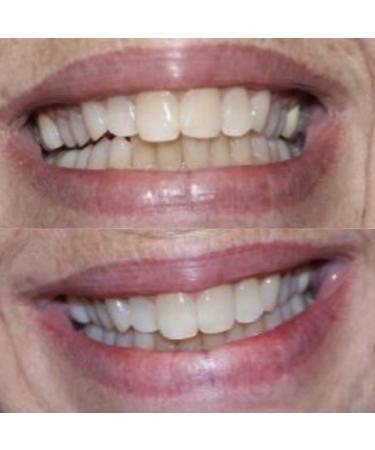Smile Science Harley Street Professional Activated Charcoal Teeth Whitening Powder - Buy Online on GoSupps.com