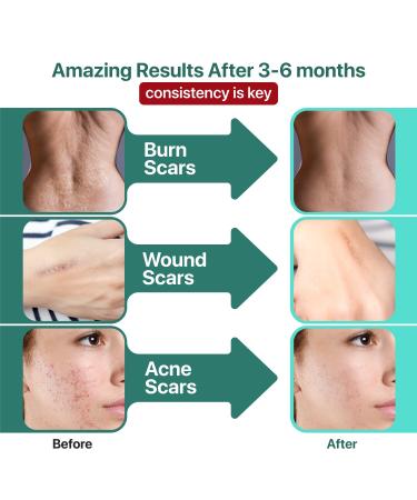 Ebanel Silicone Scar Gel 1 Oz + Hyaluronic Acid Serum Bundle - Advanced Skincare Treatment - Buy Online on GoSupps.com