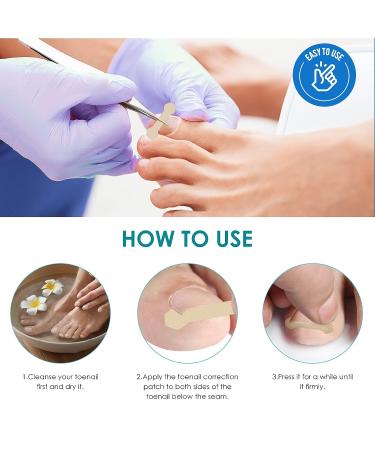 Professional Ingrown Toenail Treatment Kit - 60PCS Corrector Patch, File, and Lifter - Painless Pedicure Tool Set - Buy Online on GoSupps.com