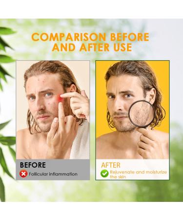 RedOceansM Acne grease and acne cream antipimple gel 20 g acne cream suitable for most skin types - Buy Online on GoSupps.com