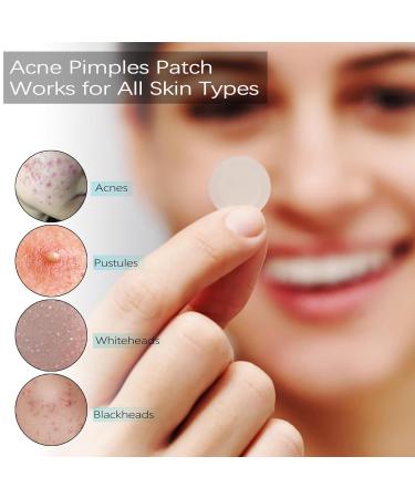 VonTeok Acne Pimple Patches (144 Patches) Ultra-Thin Hydrocolloid Stickers with Tea Tree Oil for Fast Redness Relief & Concealment of Zits Blemishes Spots - Buy Online on GoSupps.com