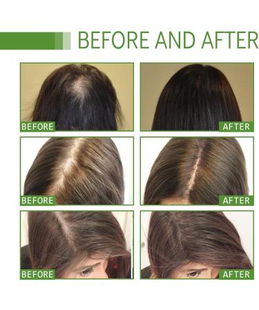 Shelure Hair Regrowth Oil 60ml Hair Growth Oil Hair Regrowth Treatment Makes Hair Stronger Thicker Nourishes Thinning Hair - Buy Online on GoSupps.com