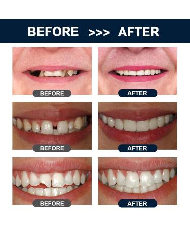 Temporary Tooth Repair Temporary Tooth Replacement Kit Temporary Moldable Tooth Moldable Teeth Granules Tooth Temporary To - Buy Online on GoSupps.com