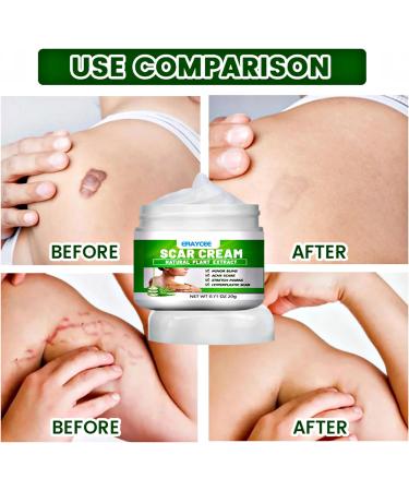 Natural Aloe Vera Scar Cream 20g Helps Soothe Acne Scars C-Section Scars Burns And Surgery Scars Works On Both Old And New Scars - Buy Online on GoSupps.com