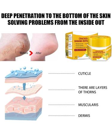  smashing smashing Chapped Feet Repair Cream | Banana Foot Repair Skin Healing Moisturizing 30g Chapped Heel Moisturizer Foot Repair for Removing Dead Skin - Buy Online on GoSupps.com