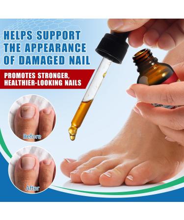 Traitement des Mycoses des Ongles 30ml - Soin Intensif l'Acide Und cyl nique 25% & Huiles Essentielles - R pare et Renforce les Ongles paissis Jaunis et Ab m s - Buy Online on GoSupps.com