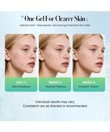 TRSTAY LUXE Acne Treatment Serum with 2% Salicylic Acid Clarifying Acne Gel for Face, Helps Treat Acne Blemishes, Reduce Redness & Control Oil Daily Acne Care for Men & Women (10ml) - Buy Online on GoSupps.com