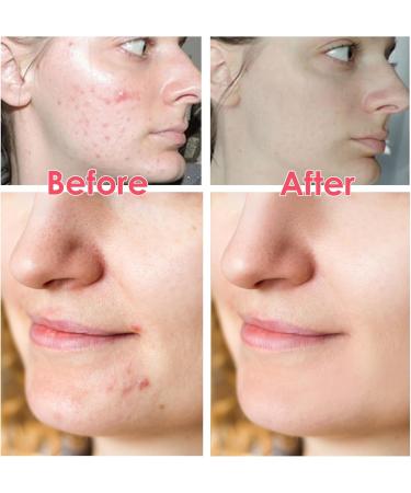 Pimple Patches Hydrocolloid Spot Remover Patches Spot Treatment Pimple Stickers Breakout Acne Patch Anti Acne Dots Made With Natural Oils Tea Tree and Calendula For Fast Acting Skincare - Buy Online on GoSupps.com