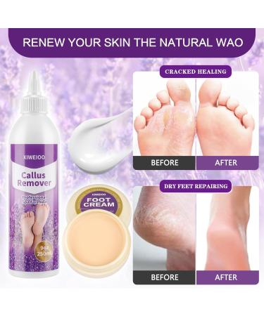 Professional Callus Remover Gel Kit - Exfoliating Cream & Tools for Home Pedicure | Extra Strength Foot Spa Supplies for Cracked & Dry Skin - Buy Online on GoSupps.com