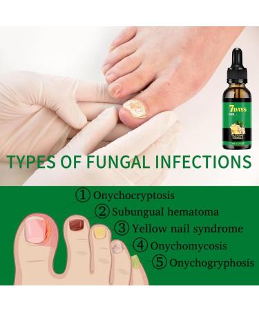 Traitement des champignons ongles de 7 jours Ginger Nail Support Nails Care 1 fl.oz S rum de r paration des ongles polyvalents pour les ongles minces cassants peelings et fissur s (2pcs) - Buy Online on GoSupps.com