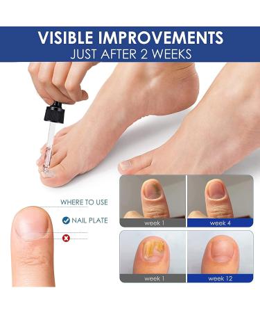 3 Pcs German Paronychia Oil for Toenail Care | Repair & Improve Toenail Health - Buy Online on GoSupps.com