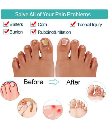 Sumiwish 16 PCs Gel Bunion Correctors & Toe Separators - Relieve Bunions Overlapping Toes & Foot Pain - Buy Online on GoSupps.com