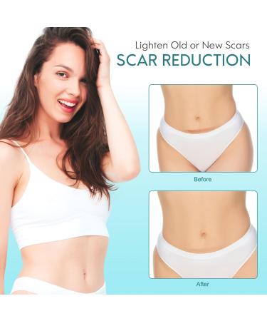 Silicone Scar Roller Tape - Reusable 4m x 4.6cm for Scar Removal & Keloid Treatment - Ideal for Caesarean Scars & Facial Scarring - Buy Online on GoSupps.com