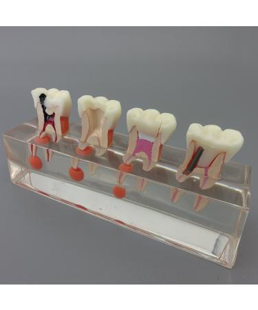 Dental Teeth Model for Endodontic Treatment - 4-Stage Teaching Aid for Studying Internationally - Buy Online on GoSupps.com