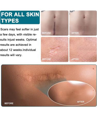 Silicone Scar Sheets 1.6x130 3.2M - Surgical, C-Section, Keloid, Burn, Acne - 125'' Length - Buy Online on GoSupps.com