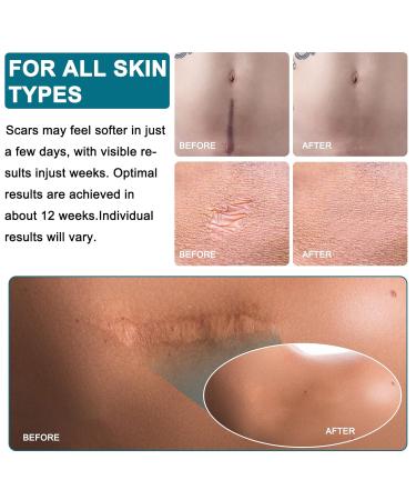Silicone Scar Treatment Rollers - Heal C-Section Burns Keloids & Acne | 4cm x 320cm | Free Shipping Worldwide - Buy Online on GoSupps.com