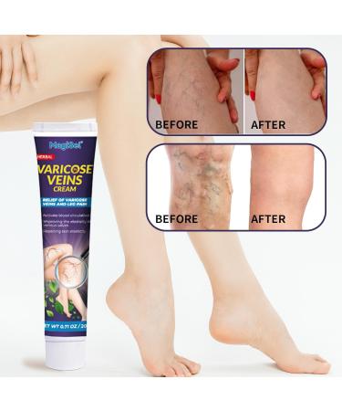  MagiSel Varicose Vein Cream Varicose Vein Cream Cream for Varicose Veins Varicose Vein Leg Treatment Suitable for Spider Veins Improves Blood Circulation Quickly Relieves Tired Legs 20g - Buy Online on GoSupps.com