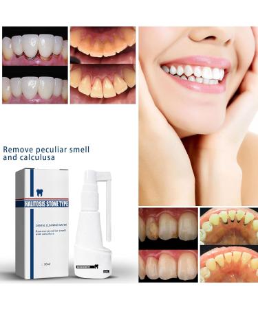 Pulv risateur dentaire Spray Calculusfree - Nettoyant pour tartre dentaire - Blanchisseur de dents - Rafra chissant buccal - liminateur de tartre (1 pi ce) 1 Pi ce. - Buy Online on GoSupps.com