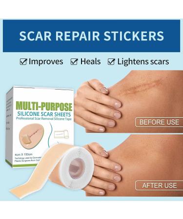 Medical Grade Silicone Scar Sheets - 1.6 x 60 inches - C-Section, Keloids, Tummy Tuck - Reduce Scarring and Promote Healing - Buy Online on GoSupps.com