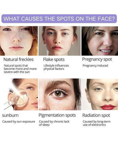 Dark Spot Remover for Face Spot Cream Dark Spot Corrector Skin Lightening Cream Pigmentation Removal Cream Dark Spot Correcting Glow Serum for Melasma Freckle Sun Spot Remover Blemish Reduction - Buy Online on GoSupps.com