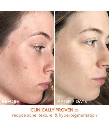 Dr. Dennis Gross Alpha Beta Universal Daily Peel - 5 Treatments for Uneven Tone, Fine Lines, & Enlarged Pores - Buy Online on GoSupps.com