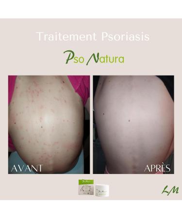 PSO NATURA Foaming Regenerating Complex Psoriasis eczema redness dander 94% clinically proven efficacy on psoriasis Only 100% natural treatment recognized Medical Device - Buy Online on GoSupps.com
