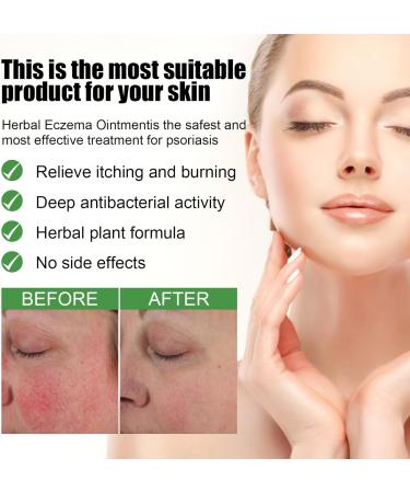 Antifungal Cream:Jock Itch Cream Soothing Eczema Relief Cream All-Natural Soothing Care & Fast Relief of Jock Itch Eczema Psoriasis - Ringworm Treatment for Humans - for Adults and Kids - Buy Online on GoSupps.com