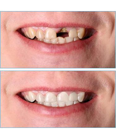 YTXY Cosmetic Teeth Prostheses - Instant Veneers & Dental Silicone Temporary Tooth Whitening | 2 Pairs for Denture Repair & Brace Covers - Shop Now! - Buy Online on GoSupps.com