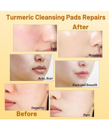 2 Pack Turmeric Soap Bar & Exfoliating Pads - Cleanse & Moisturize Acne Scars | Vitamin B5 & Lemon Infused - Buy Online on GoSupps.com