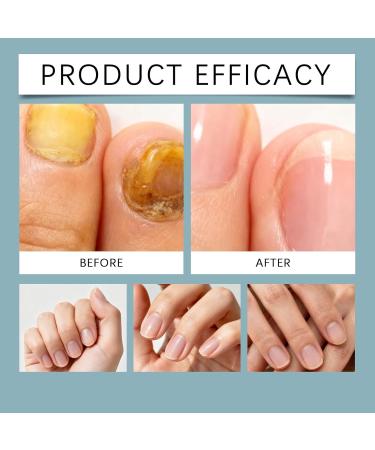 Huile de soin des ongles 3 jours la k ratine et aux acides amin s fortifiante pour ongles fragiles et ab m s huile pour cuticules et ong/les de pieds huiles de croissance quotidienne. (4PCS) - Buy Online on GoSupps.com