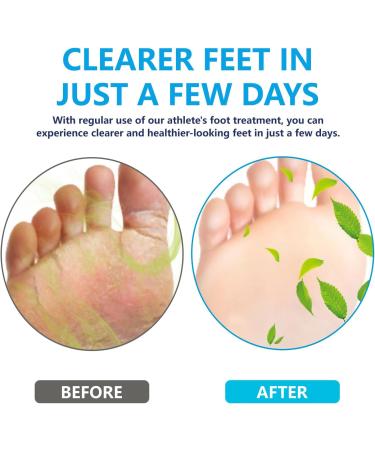 TUITUII Athletes foot gel athletes foot cream against itching athletes foot cream unpleasant odors 20 g deodorant foot cream athletic ingredients effective lightness soothes itching - Buy Online on GoSupps.com