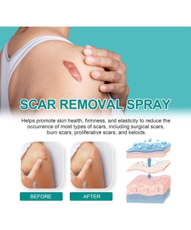 Scar Remove Advanced Spray - Acne Scar Treatment for Face, Dark Spot Remover - Gentle Skin Care - 1pcs - Buy Online on GoSupps.com