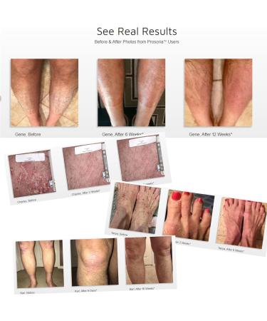 Prosoria Psoriasis Treatment System - Clinical Strength with Natural Botanicals | Soften, Restore & Treat Skin | 2 Fl Oz (Pack of 2) - Buy Online on GoSupps.com