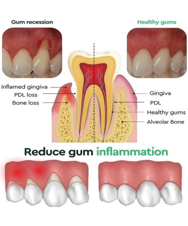 Qosneoun Dentizen Gum Regrowth Drops Dentizen Drops Receding Gum Repair Gum Disease Treatment for Gum Health (3) - Buy Online on GoSupps.com