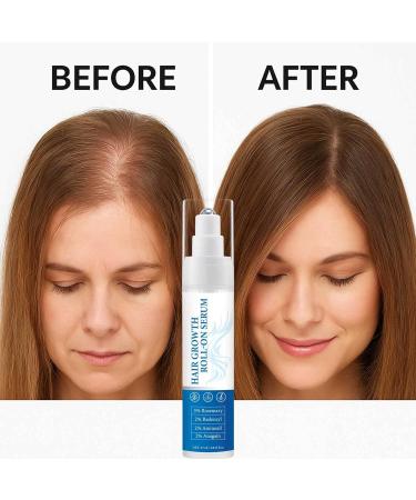 S rum capillaire roll-on au romarin pour la croissance des cheveux 25 ml contr le la chute des cheveux soin naturel du cuir chevelu contr le des frisottis chez les personnes g es (5) - Buy Online on GoSupps.com