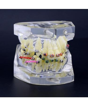 Orthodontic Tooth Model Orthodontic Dental Treatment Malocclusion Model with Brackets Chain Wire - Buy Online on GoSupps.com