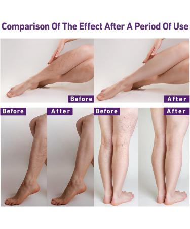 Varicose Vein Cream 3.53 Oz | Soothing Cream for Varicose & Spider Veins | Effective Relief for Legs - Buy Online on GoSupps.com