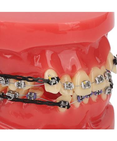 Orthodontic Bracket Model - 24 Teeth Demonstration Model with Metal Wires & Brackets for Dental Education - Buy Online on GoSupps.com