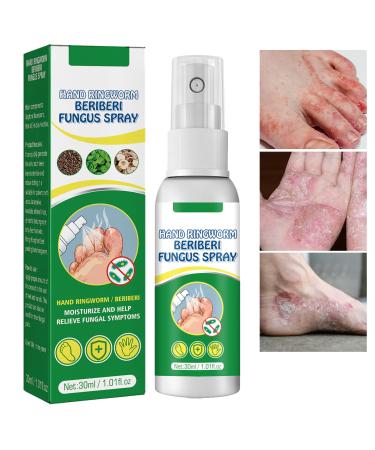Athletes Foot Treatment Spray Anti-fungi Treatment for Feet Itchy Sweating Peeling and Blisters Natural Ingredients Foot Fungi Spray for Tinea Pedis