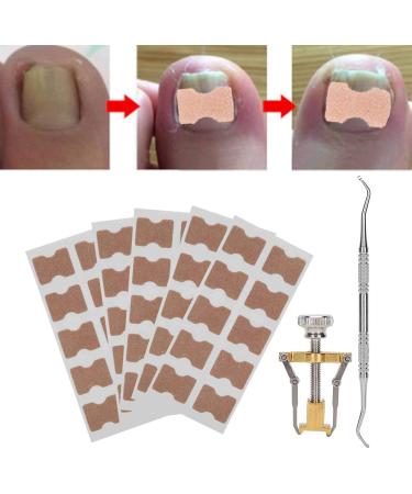 Ingrown Toenail Treatment Ingrown Toenail Corrector Ingrown Toenail Correction Patch Fixer Pedicure Toenail Correction Patch Sticker Foot Care Tool Ingrown Toenail Corrector Strips Foot Care Kit - Buy Online on GoSupps.com