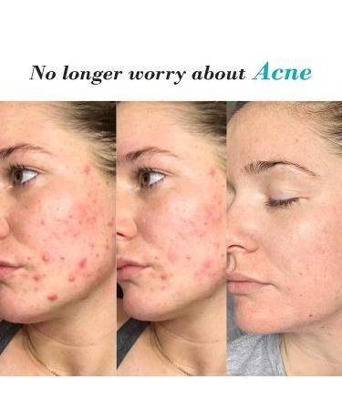 ZealSea Azelaic Acid 10% Facial Cream - Redness Relief, Rosacea & Acne Treatment, 1 oz - Buy Online on GoSupps.com