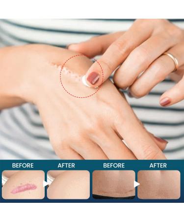 RedOceansM Scar gel scar removal cream scar care gel scar repair cream stretch mark creams remover 20 g scar ointment after use natural scar gel reduces the visibility of - Buy Online on GoSupps.com